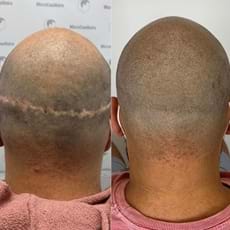 Scalp micropigmentation in Winston Salem, NC